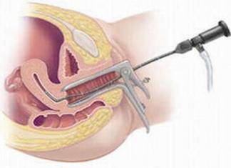 Гистероскопия с удалением полипа в матке: показания, особенности проведения и восстановления